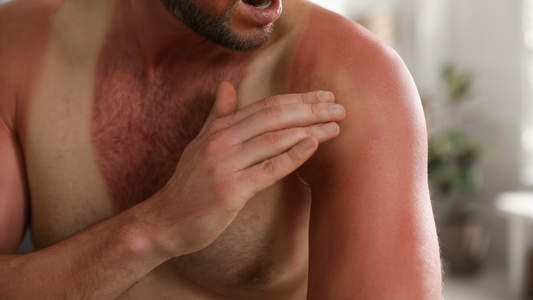 Sunburn